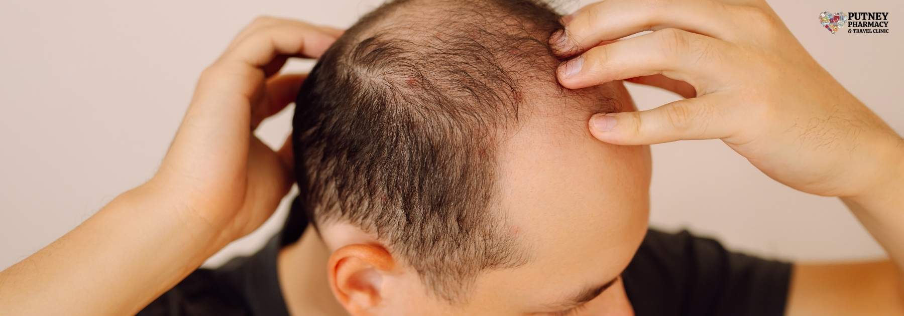 hair loss clinic putney